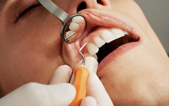 Cum tratăm durerea de dinți