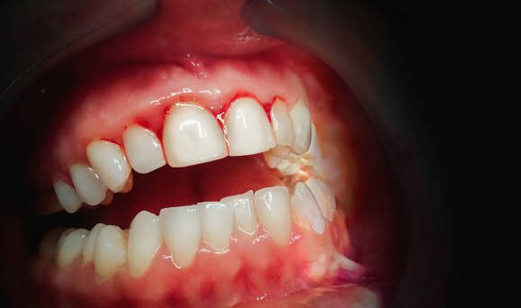 Gingivectomia și alte proceduri pentru sănătatea gingiilor tale