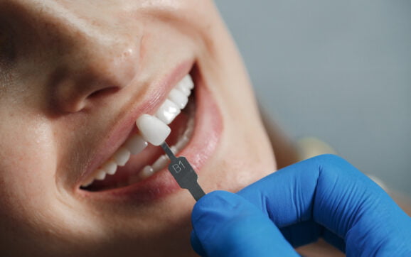 Cum se face pregătirea înainte de aplicarea fațetelor dentare?