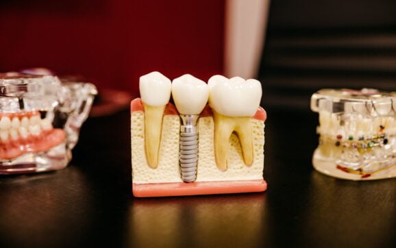 Implantul dentar: 3 mituri pe care NU trebuie să le mai crezi
