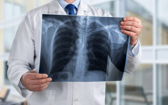 Cancerul pulmonar: Ce este și câte tipuri există